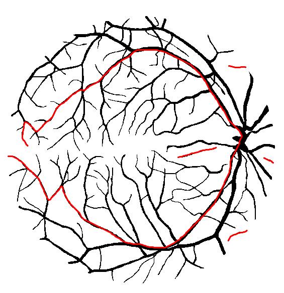 Computation of the geodesic diameter on a segmented image from the DRIVE database (Staal et al., 2004). Each connected component was associated to a label, then the longest geodesic path within each connected component was computed and displayed as red overlay.